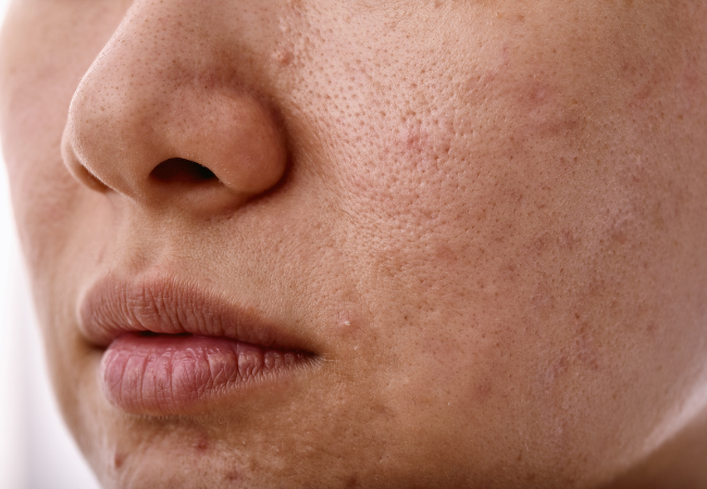 Barrier related breakouts showing tiny bumps redness dry patches and irritated skin texture