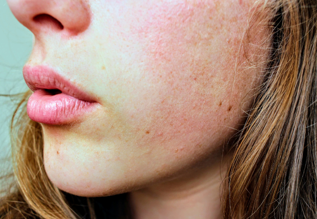 Damaged skin barrier causing breakouts with irritated acne prone skin redness dryness and rough texture