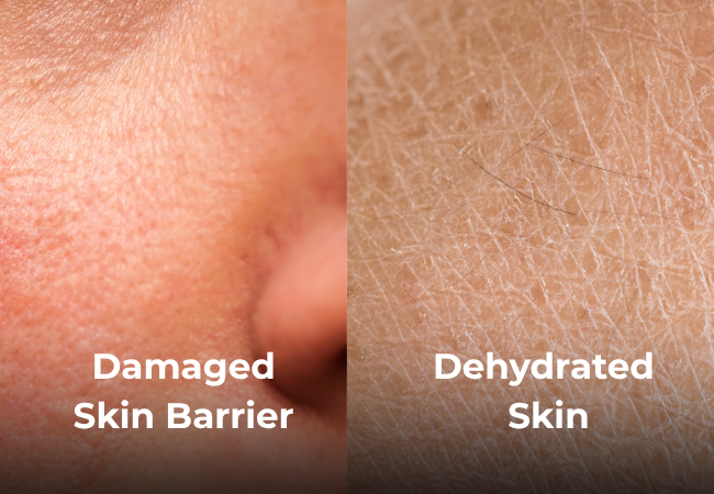 Damaged skin barrier vs dehydrated skin comparison showing dull tight skin and reactive irritated facial texture