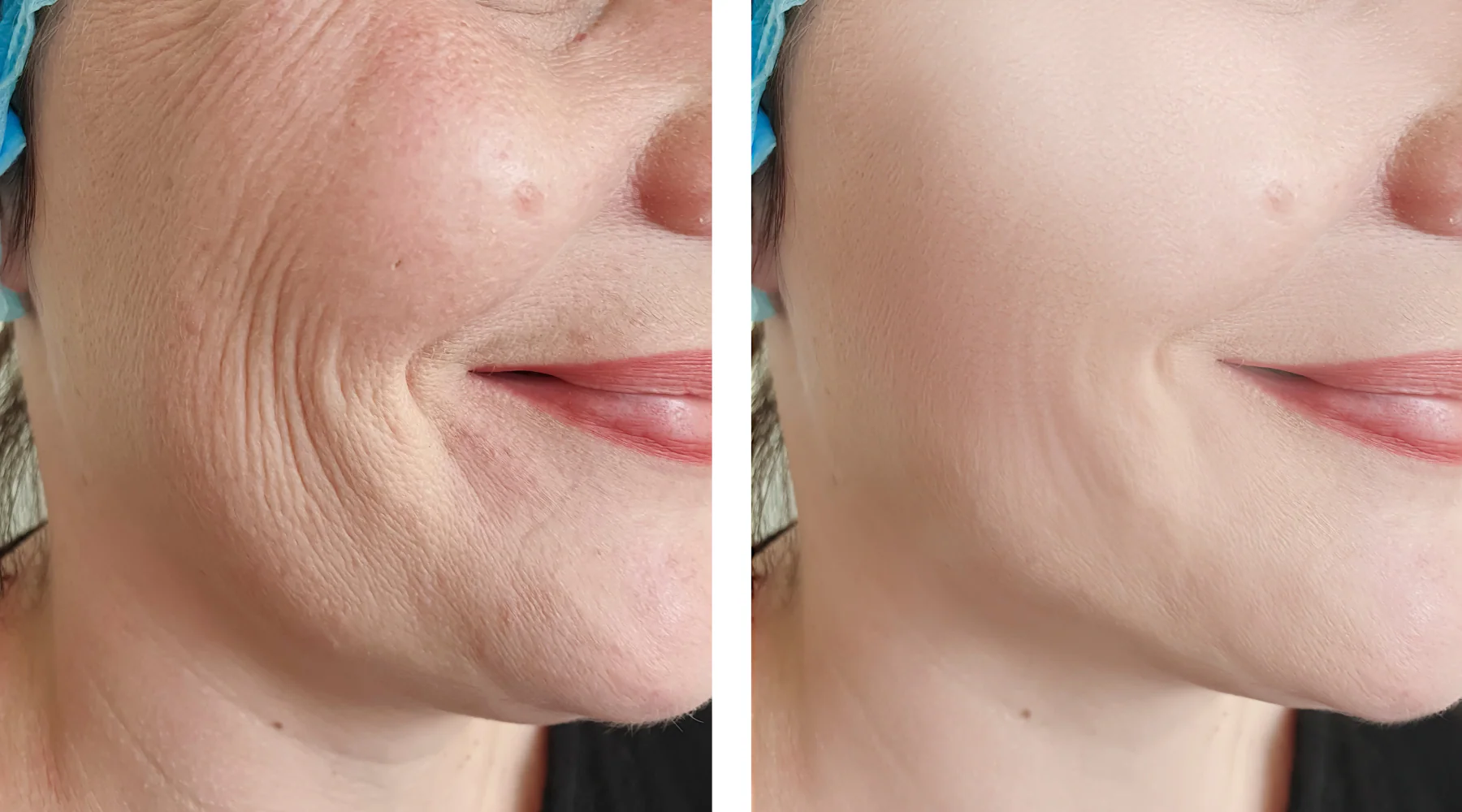 Before and after example of Ozempic face showing facial volume loss and deeper nasolabial folds after rapid GLP-1 weight loss.