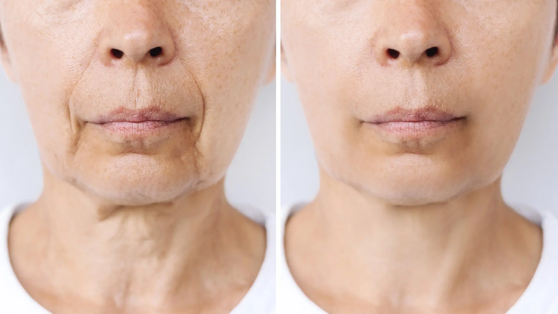 Ozempic face before and after showing facial volume loss and skin sagging after rapid weight loss from GLP-1 medication.