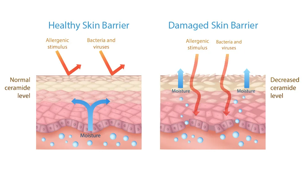 Diagram comparing healthy skin barrier with normal ceramide levels versus damaged skin barrier showing moisture loss and weakened protection.